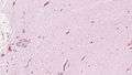 Aggressive angiomyxoma.jpg