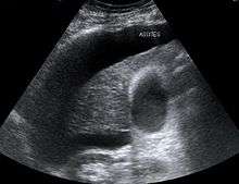 Ultrasound showing ascites as a dark area in the abdomen